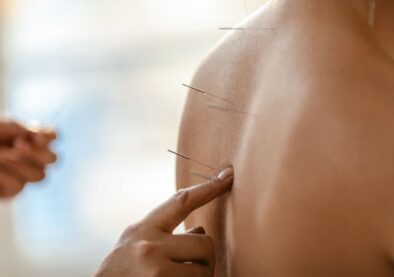 βελονισμός