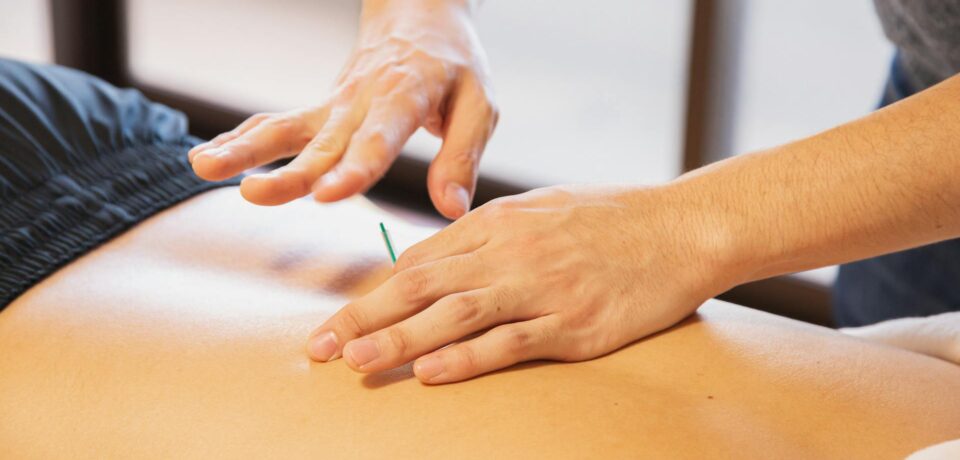 βελονισμός